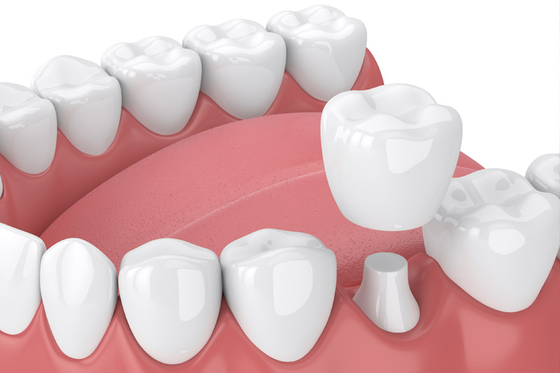 Dental Crowns in Oradell