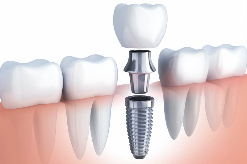 Implants Dentist in Oradell