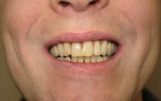 before-dental crowns